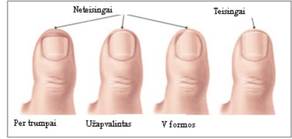 Ar teisingai kerpate nagus? 